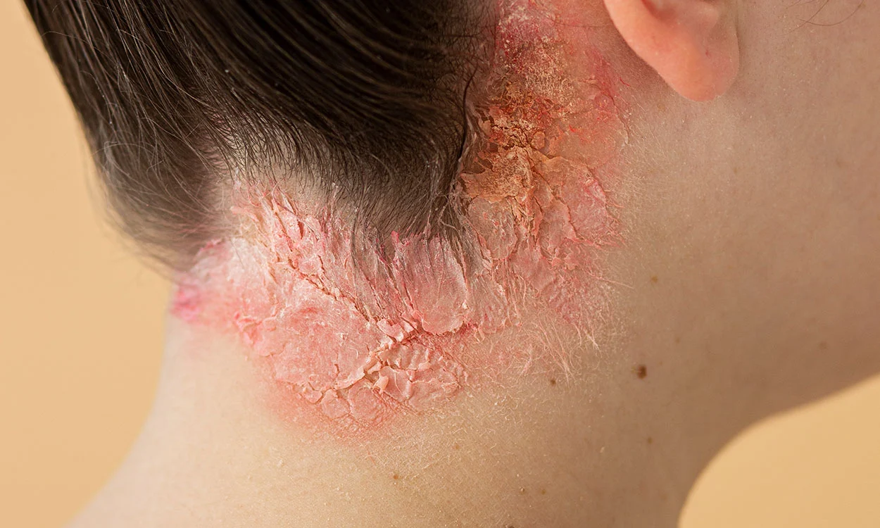 La dermatitis y su relación con el sistema nervioso